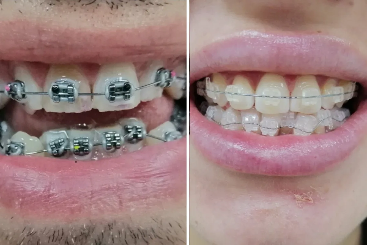 Poređenje metalnog i safirnog fiksnog aparata na zubima, levo metalne bravice, desno providne safirne